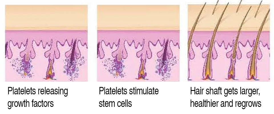 PRP Treatment Inverness