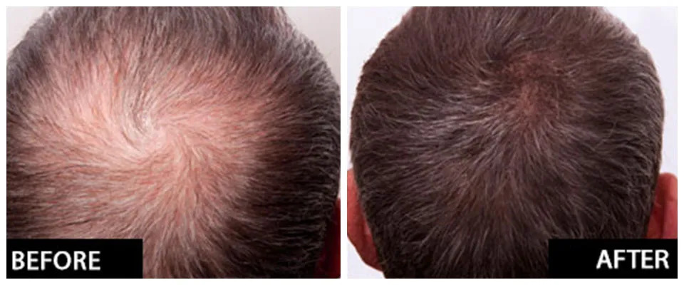 PRP Treatment Inverness