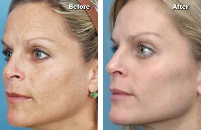 Photo Rejuvenation Inverness