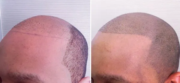 Scalp Tattooing Inverness